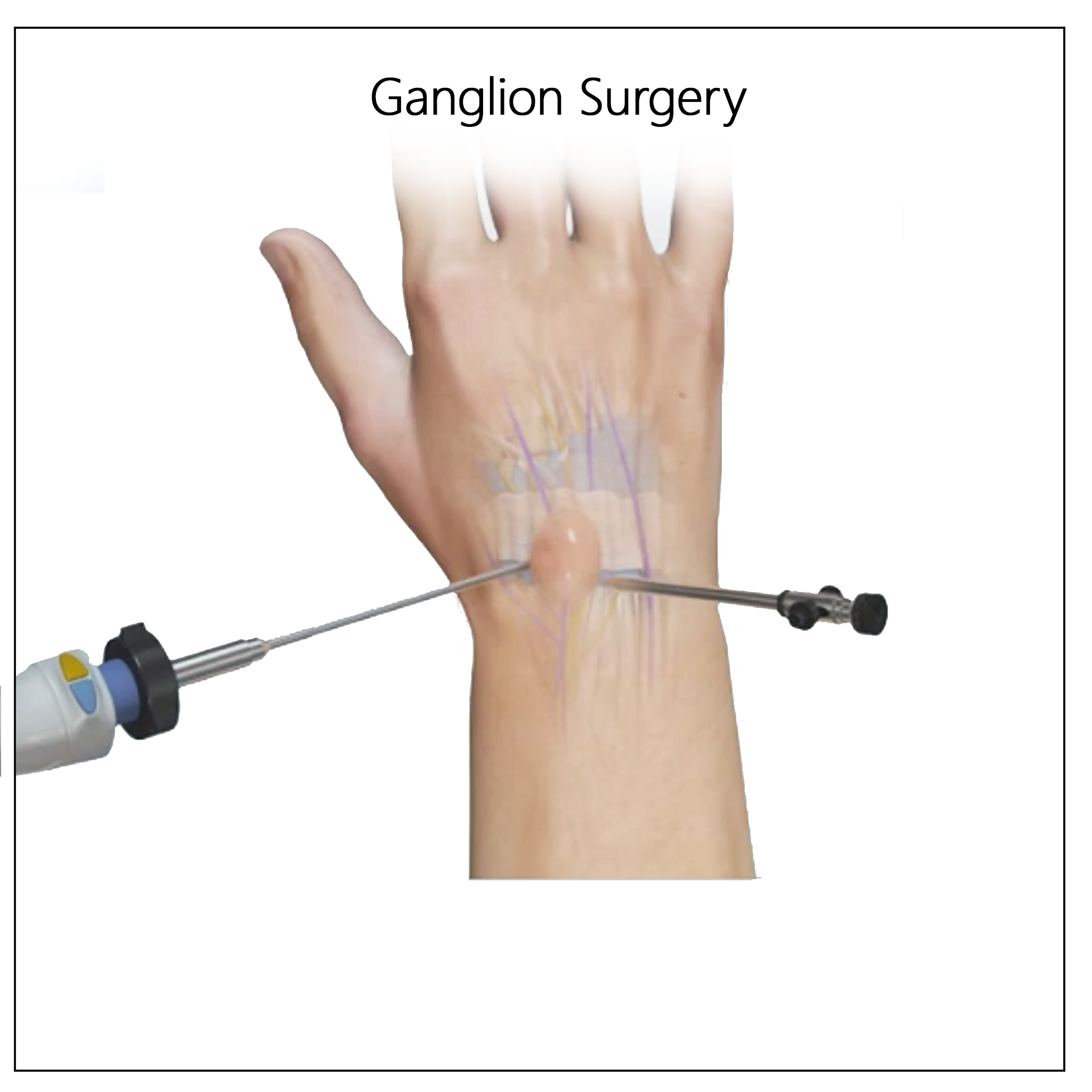 Ganglion Removal Surgery